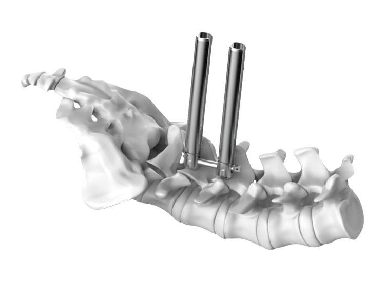 Sistema Long Arm da GS Medical para estabilização da coluna